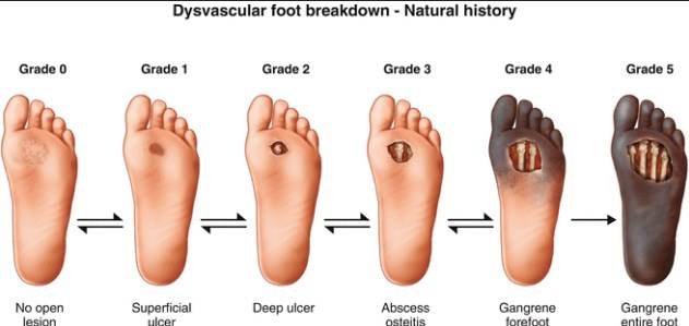 the diabetic foot)