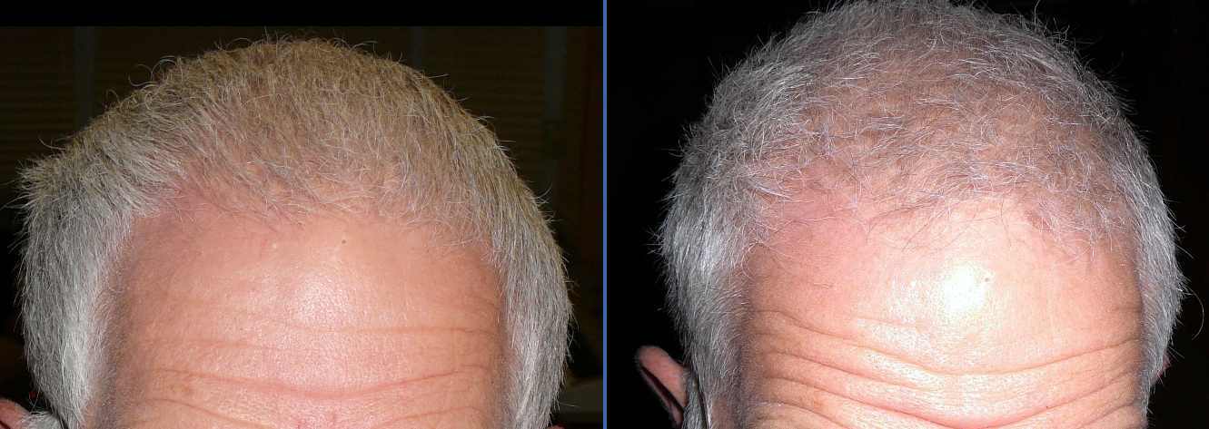 Vitamin D Deficiency Hair Loss