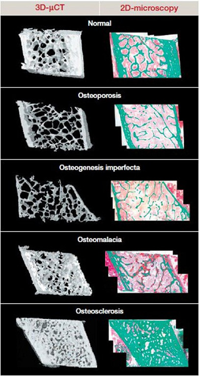 osteomalacia vs osteoporosis