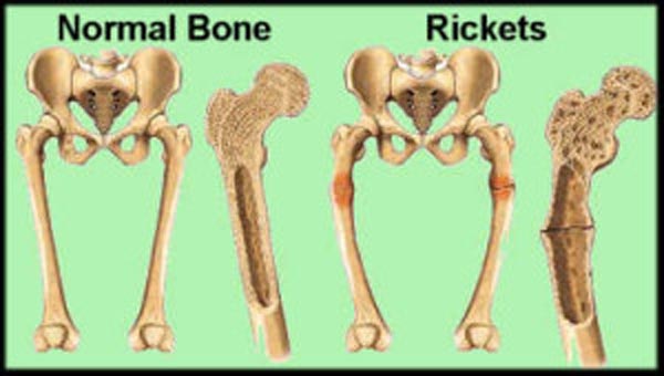 Overview of Rickets and Vitamin D | VitaminDWiki