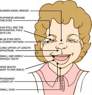 Ongekend Williams-Beuren Syndrome (rare) and too much Vitamin D | QF-08