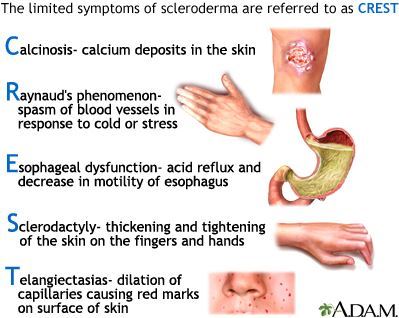 Sclerodoma And Vitamin D Deficiency