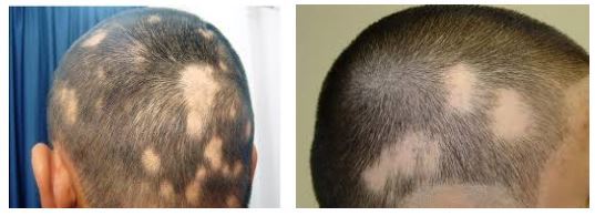 Hair Loss Strongly Associated With Poor Vitamin D Receptors