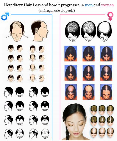 Hair Loss Strongly Associated With Poor Vitamin D Receptors