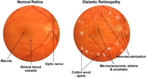 vitamin a deficiency retina