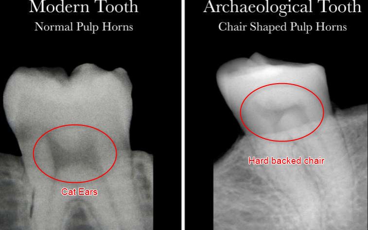 Vitamin D deficiency indicated by pulp tooth shape (X ray)– Nov