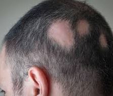 Alopecia Areata Spot Baldness Associated With 85 Ng Lower