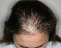 Alopecia Areata Spot Baldness Associated With 85 Ng Lower